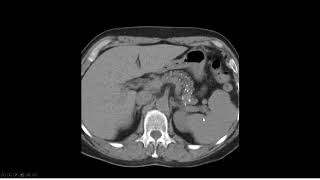 Pancreatite crônica calcificante [upl. by Enela]