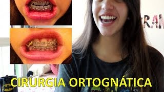 Cirurgia Ortognática  Manual de Sobrevivência Débora Aladim [upl. by Nandor]