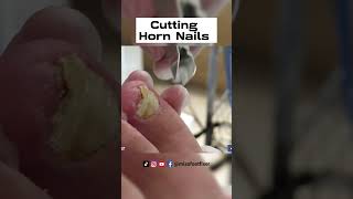 Cutting Severe Rams Horn Nails Miss Foot Fixer Marion Yau [upl. by Rein]