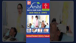 Say Goodbye to Skin Tags and DPNs Effective Treatment Solutions at Arshi Clinic arshi ytshorts [upl. by Colene965]