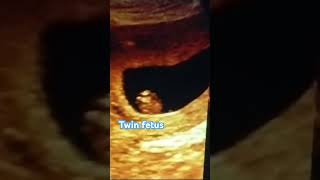 Ultrasound of fetal well being Twin CRL Monochronic amp Monoamnotic youtubeshorts shorts pregnacy [upl. by Ettelocin415]