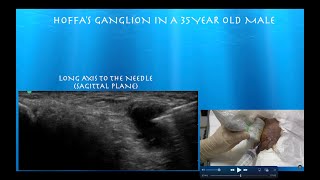 Ultrasound Guided Aspiration and Injection of a Hoffas Fat Pad Ganglion [upl. by Lebar]