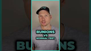 Bunions vs Normal Feet Can Foot Exercises Correct Bunions [upl. by Concettina]