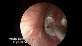 ENDOCSOPIC MUCOID OTITIS MEDIA DRAINAGE [upl. by Raoul]