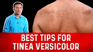 Best Tips for Tinea Versicolor Treatment Skin Fungus – Dr Berg [upl. by Adrell]