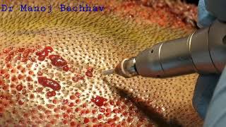 Hair Transplant FUE TechniqueHair graft harvesting [upl. by Nenad]