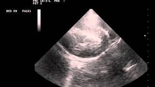 cardiomegaly and hypertrophy due to an adrenal pheochromocytomaavi [upl. by Akenna585]