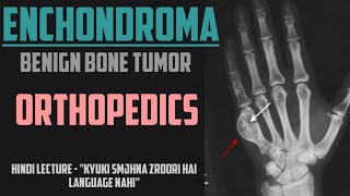 Enchondroma  Benign Bone Tumor  Orthopedics 9  NEET PG [upl. by Oivlis]