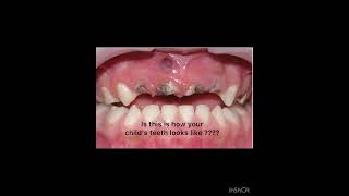 Ever seen your child’s teeth carefully [upl. by Sowell]