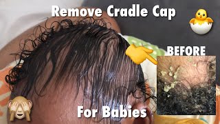 Completely Remove Cradle Cap Sped Up  Visual ASMR  No Music [upl. by Arreyt]