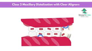 Maxillary Molar Distalization with Invisalign [upl. by Nathaniel]