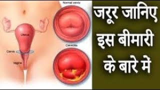 गर्भाशय ग्रीवा शोथ │ यौन संक्रमण रोग │ Cervicitis Symptoms amp Causes [upl. by Warfield]