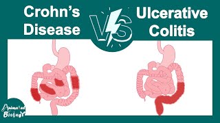 Crohns disease vs Ulcerative colitis  Pathology  USMLE step 1 [upl. by Franky]