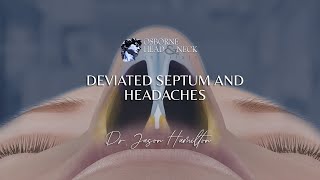 Deviated Septum and Headaches [upl. by Schulz]