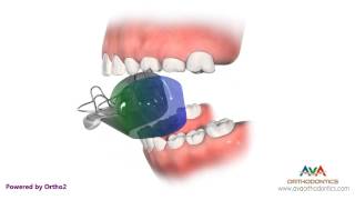 Orthodontic Treatment for Overjet Overbite  Bionator Appliance [upl. by Ernestus]