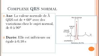 TD de Cardiologie Troubles de lexcitabilité ventriculaire [upl. by Gainer]