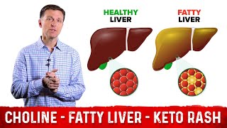 Choline One of The Best Vitamins for Fatty Liver – Dr Berg [upl. by Gillead]