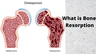 What is Bone Resorption [upl. by Goldina]