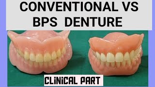 BPS DENTURE clinical procedure part [upl. by Scottie529]