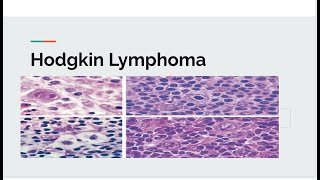 Hodgkin lymphoma [upl. by Pauly880]