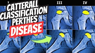 Catterall Classification of LeggCalve Perthes Disease [upl. by Herzen]