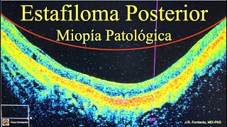 Estafiloma Posterior Miopía Patológica [upl. by Lupien163]