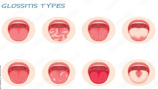 Glossitis benign migratory glossitis geographic tongue [upl. by Naugal795]