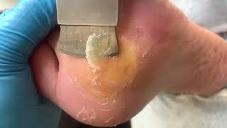 Callus removal from feetampFoot scraping dead skin【Xiao Yan pedicure】stress 71 [upl. by Thun]