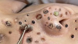 Blackhead Removal With Sac Dep Spa 1000456 [upl. by Antoni603]