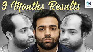 JawDropping 9Month Hair Transplant Transformation  Medlinks Hair Transplant Delhi [upl. by Nadbus]