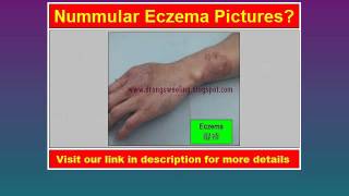 Nummular Eczema Pictures [upl. by Eboh]