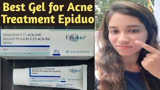 Epiduo Gel for acne amp acne scars  Gel to get rid of pimples  Best cream for acne treatment at home [upl. by Aziza]