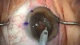 Modern Cataract Surgery Alcon ReSTOR IOL with LRI [upl. by Gurolinick]