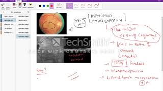 Hypotonous maculopathy [upl. by Anigal]