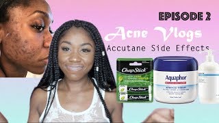 Skin  Side Effects of Accutane  The Purge Week 2  Shanese Danae [upl. by Anivas580]