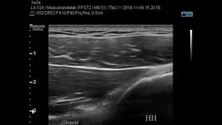 Dynamic Ultrasonography of A Patient with Posterosuperior Labral Tear Part 2 [upl. by Thema]