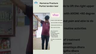 Ligament tear Patient testimonial DrLRakesh MD Panchakarma [upl. by Knorring]