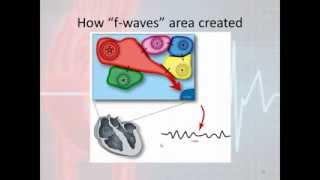 Basic Electrophysiology part 7  Atrial Rhythms part 3 Atrial Fibrillation and Atrial Flutter [upl. by Rabush]