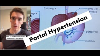 COMPLICATIONS of Portal Hypertension EXPLAINED [upl. by Walling]