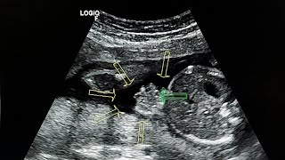 Gastroschisis ultrasound case [upl. by Ardene874]