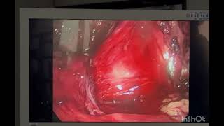 Laparoscopic extraperitoneal anatomy of inguinal hernia [upl. by Fields]