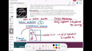 Pulsus paradoxus cardiology 110  First Aid USMLE Step 1 in UrduHindi [upl. by Turne]