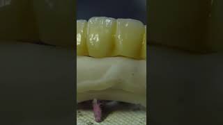 Coronas y carillas de Zirconio impresión dental en 3d odontologia ecuador art guayaquil [upl. by Settle]