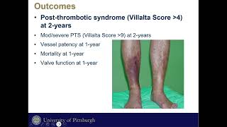 Post Thrombotic Syndrome Morbidity In Mechanical Thrombectomy Vs CDT of Iliofemoral DVT [upl. by Mohl996]