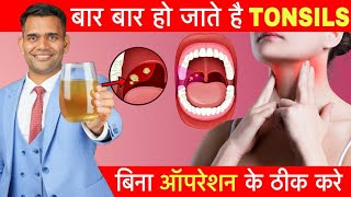 बिना Operation के Tonsils घर में ठीक करें  Tonsillitis Home Remedies [upl. by Atneuqal]