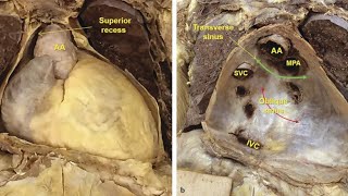 Sinuses of pericardium  heart Anatomy [upl. by Naoma]