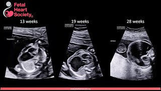 2023 ASE Fetal Echocardiography Guideline Update Progressive Fetal Cardiac Lesions [upl. by Iphagenia748]