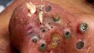 blackhead removal nose  blackhead removal  Say Goodbye to Blackheads  Nose blackheads [upl. by Gerger]