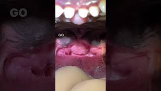 Elongated Soft Palate in French Bulldog amp BOAS [upl. by Netsryk]