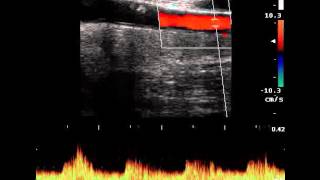 ANONYMOUS TRUNK STENOSIS [upl. by Danby671]